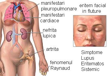 Simptome Lupus Eritematos Sistemic